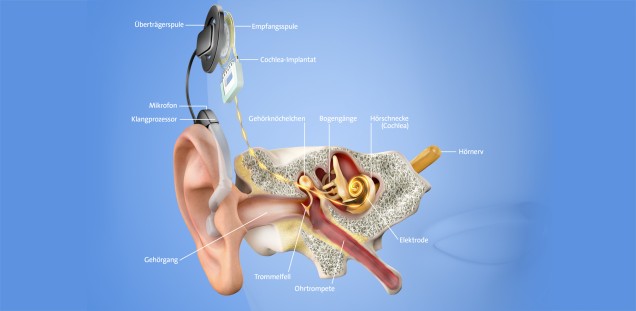Cochlea-Implantat-Versorgung professionell im UKE