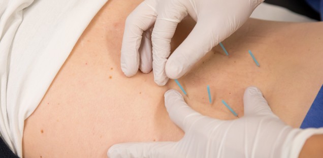Alternative Methoden wir Akupunktur können Schmerzen lindern helfen