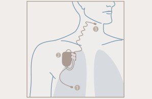 Technische Zeichnung: Darstellung des Herzschrittmachers mit Nummerierung der Punkte 1 in der Lunge, 2, in der Nähe des Schlüsselbeins und 3 in Gaumennäche