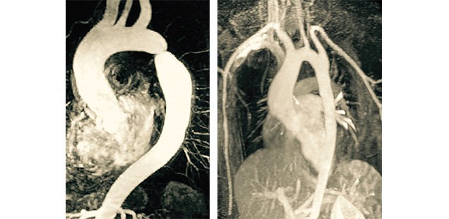 Gut erkennbar links oben die Einkerbung des Aortenbogens. Zum Vergleich: ein gesunder Aortenbogen rechts