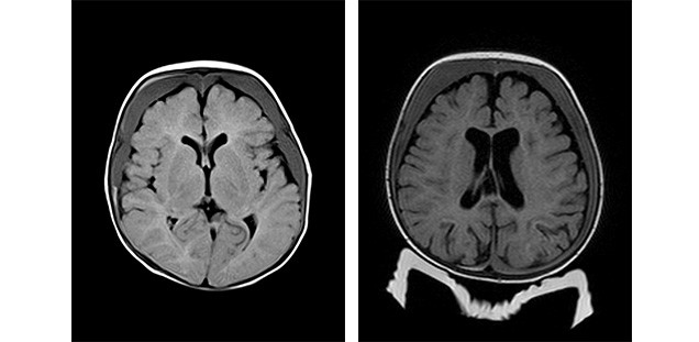 Mit bildgebenden Verfahren lassen sich Einblutungen im Hirn leicht nachweisen: Die beiden MRT-Aufnahmen auf diesem Bild zeigen jeweils beidseitige Blutungen, die bereits einige Zeit zurückliegen.