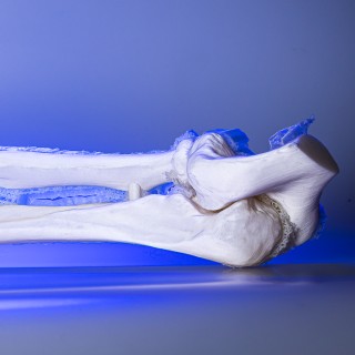 Auch in der Unfallchirurgie bietet der 3D-Druck enormes Potenzial. Operationen lassen sich besser planen, Eingriffe kürzer und schonender gestalten, Ergebnisse werden präziser. Operateure schauen sich ein gedruckte 3D-Knochenmodell an.