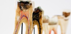 Wachsmodelle von Zähnen