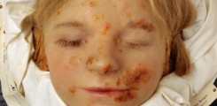 Wachsmoulage eines Mädchens mit der Diagnose "Impetigo contagiosa"