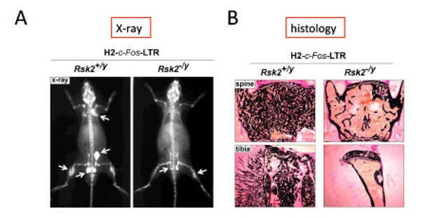 Figure 2 Reduced size of osteosarcomas in mice over-expressing c-Fos but lacking the kinase Rsk2.