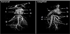 Angiographie mit einem experimentellen Kontrastmittel in koronaler und sagittaler Schnittführung. Dargestellt sind (a) linker Ventrikel, (b) rechter Ventrikel, Cc) pulmonale Arterien und Venen, (f) Portalvene, (g) Lebervenen, (h) innere Brustarterie und Vene (i) Mesenterialarterie, (j) supraaortale Arterien und Venen, (k) retroorbitaler Sinus.
