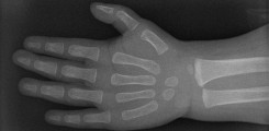 Röntgenaufnahme der kindlichen Hand