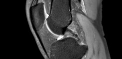 Einzelbild einer Magnetreonanztomographie des Kniegelenks