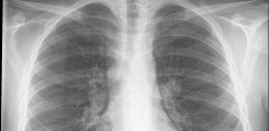 Röntgenbild des Brustkorbs