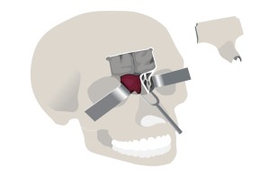 Transfrontale anteriore Schädelbasischirurgie
