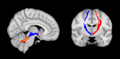 Das cerebello-thalamo-kortikale Netwerk bei der Dystonie