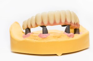 Beispielbild für eine Implantat-gestützte Zahnprothese - Zahnlabor, Zahnprothetik