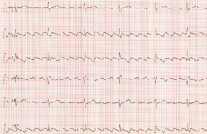 Beispiel eines typischen Vorhofflatterns im Oberflächen-EKG